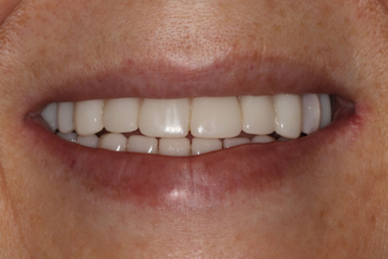 Smile after dental implant treatment