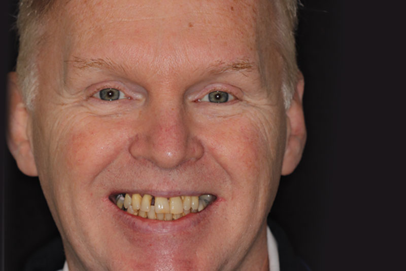 Smile before dental implant treatment