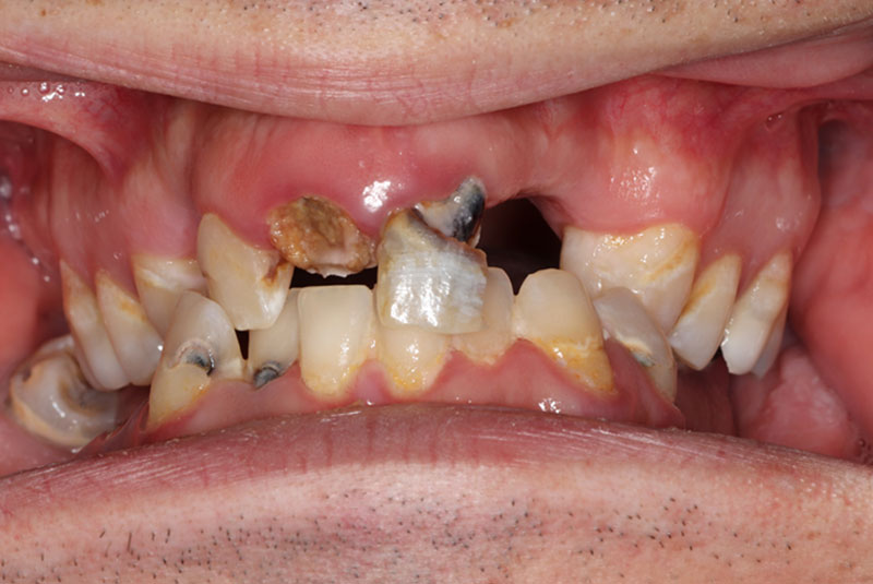 Smile before dental implant treatment