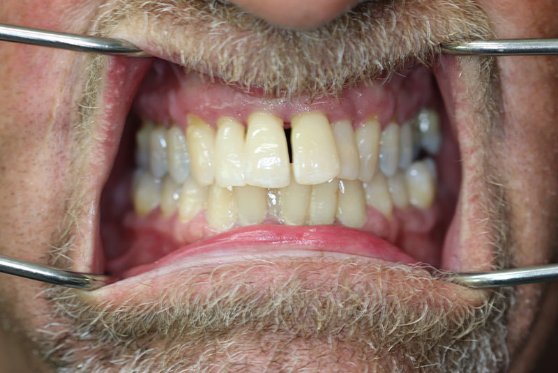 Smile before dental implant treatment