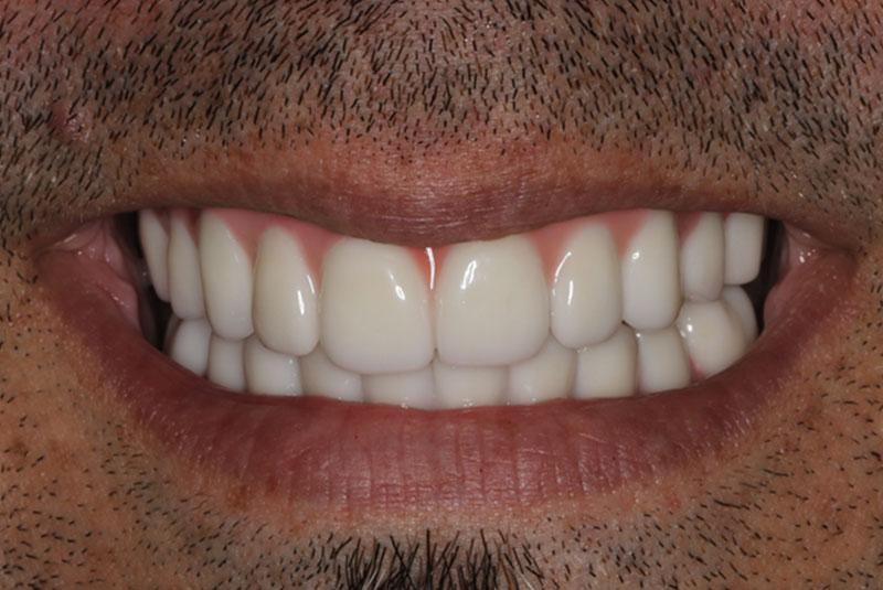 Smile after dental implant treatment