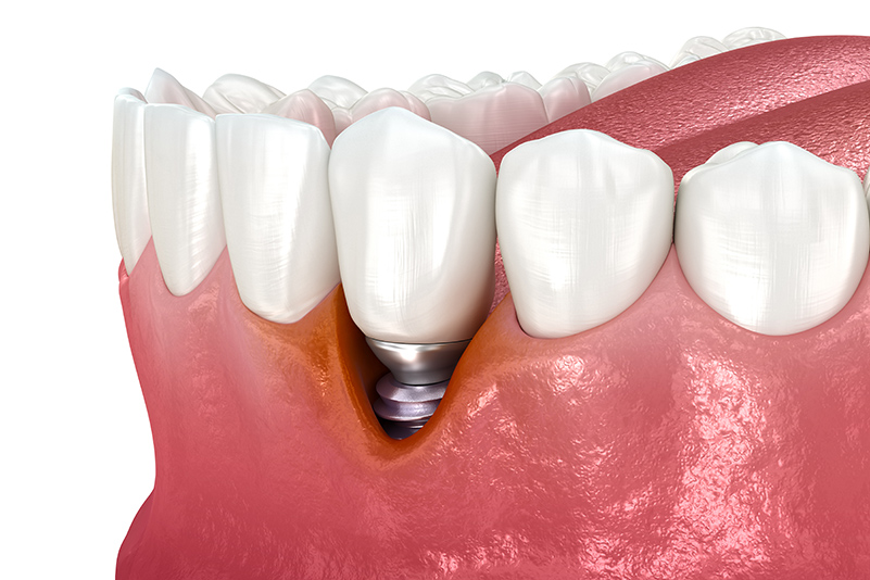 Implant treatment model used for planning a corrective case