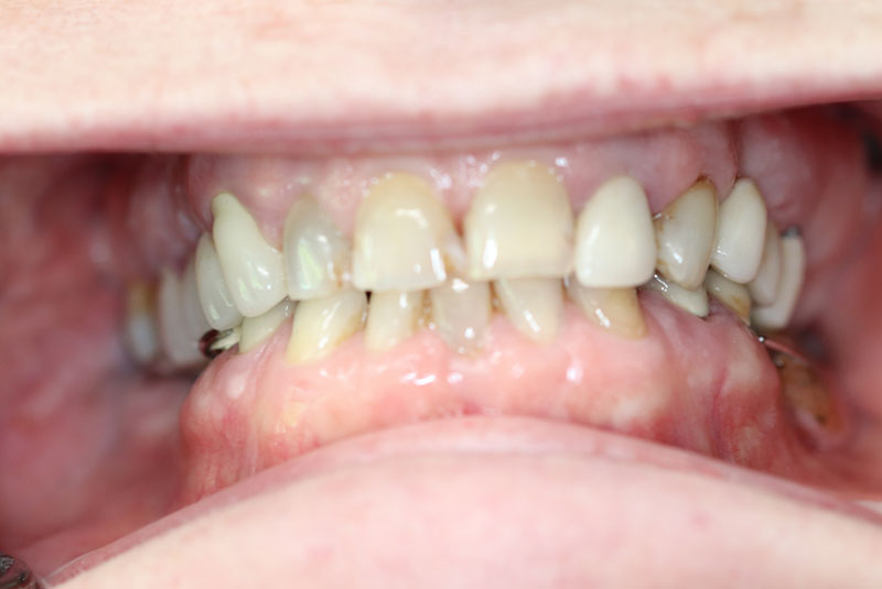 Smile before dental implant treatment