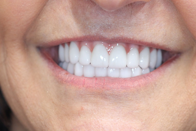 Smile after dental implant treatment
