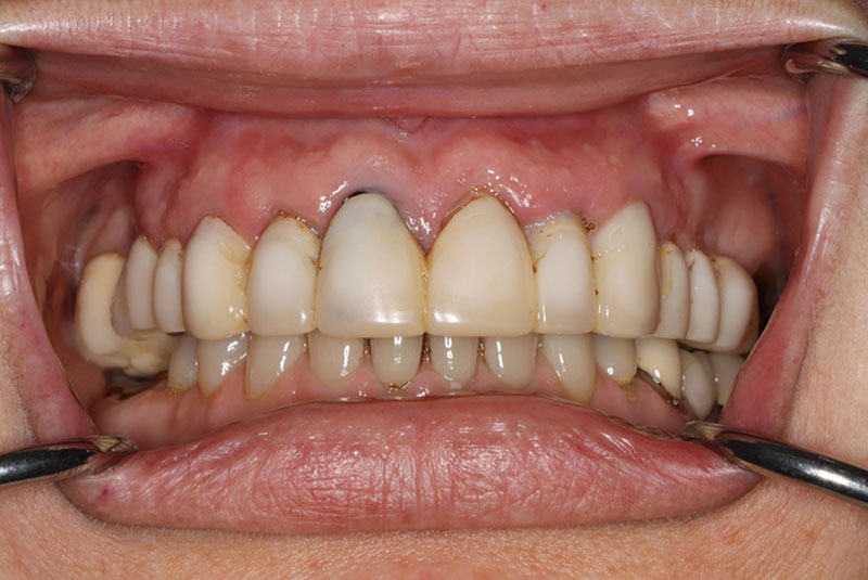 Smile before dental implant treatment