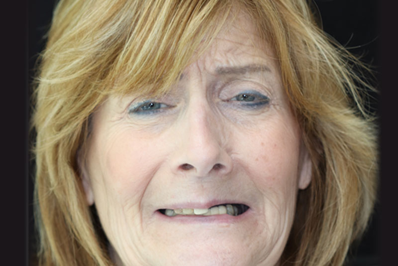 Smile before dental implant treatment