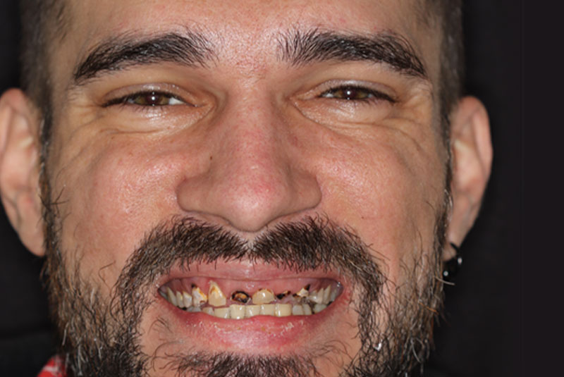 Smile before dental implant treatment