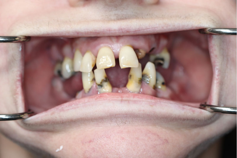 Smile before dental implant treatment