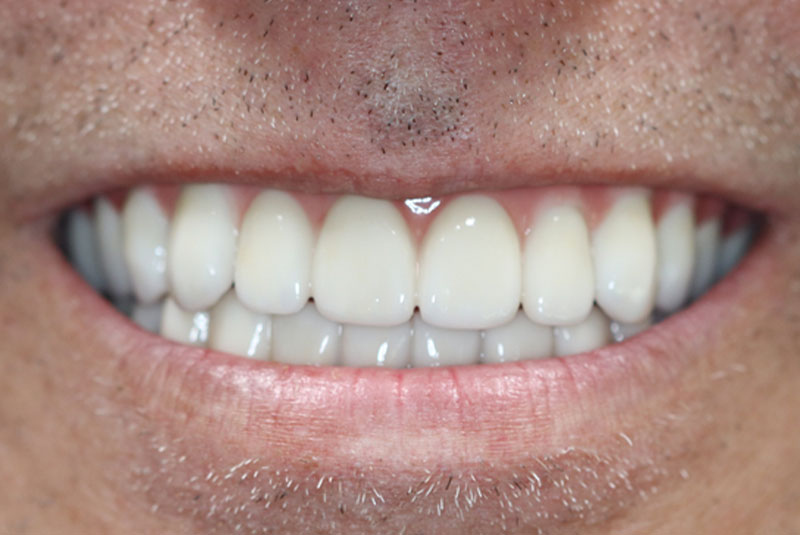 Smile after dental implant treatment