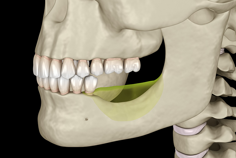 Illustration comparing healthy jawbone with resorbed bone