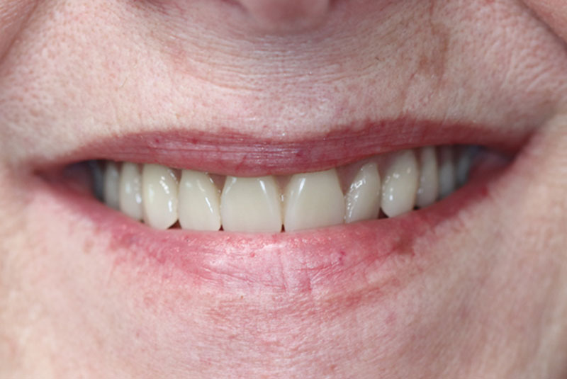 Smile after dental implant treatment