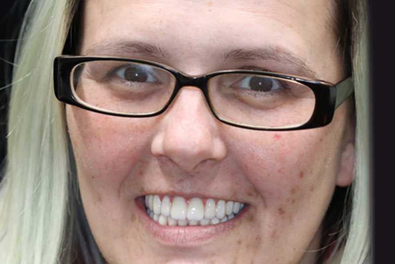 Smile after dental implant treatment