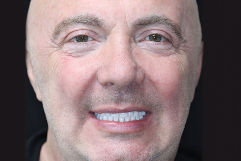 Smile after dental implant treatment