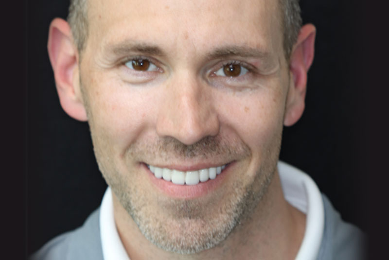 Smile after dental implant treatment
