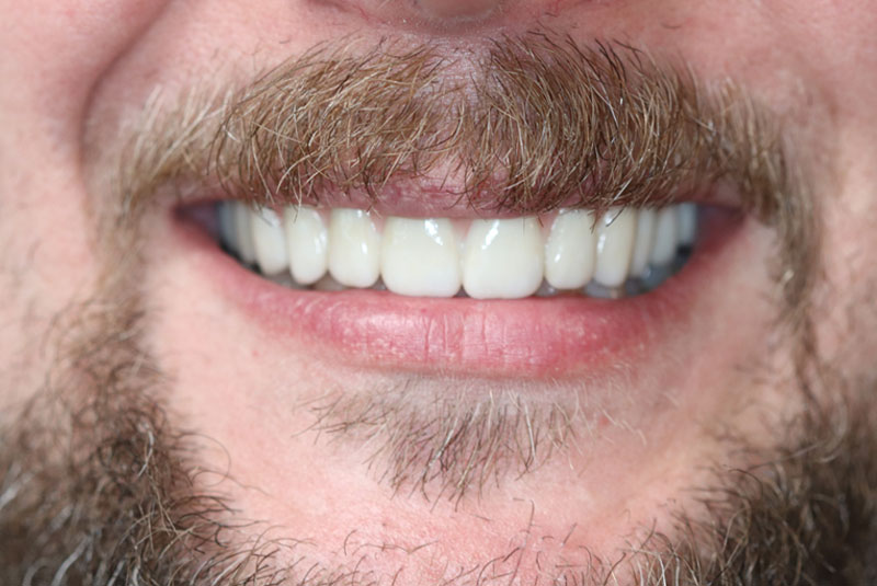 Smile after dental implant treatment