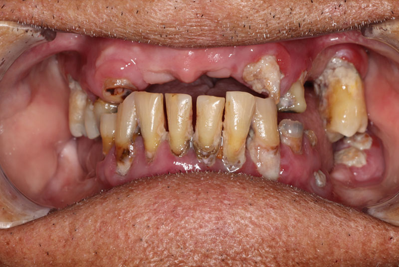 Smile before dental implant treatment