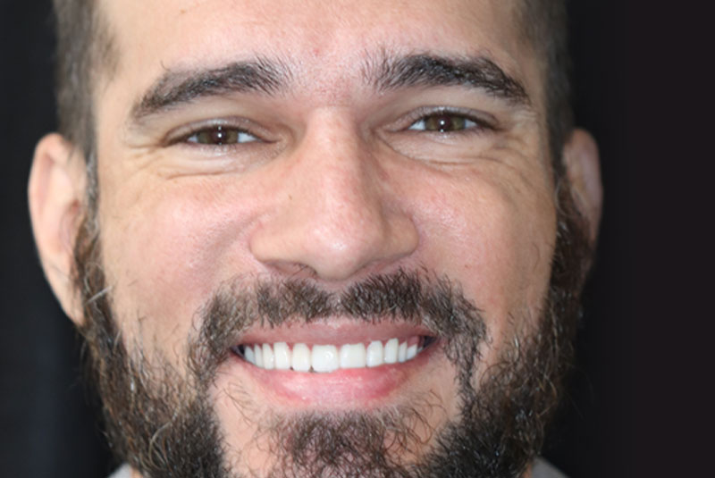 Smile after dental implant treatment
