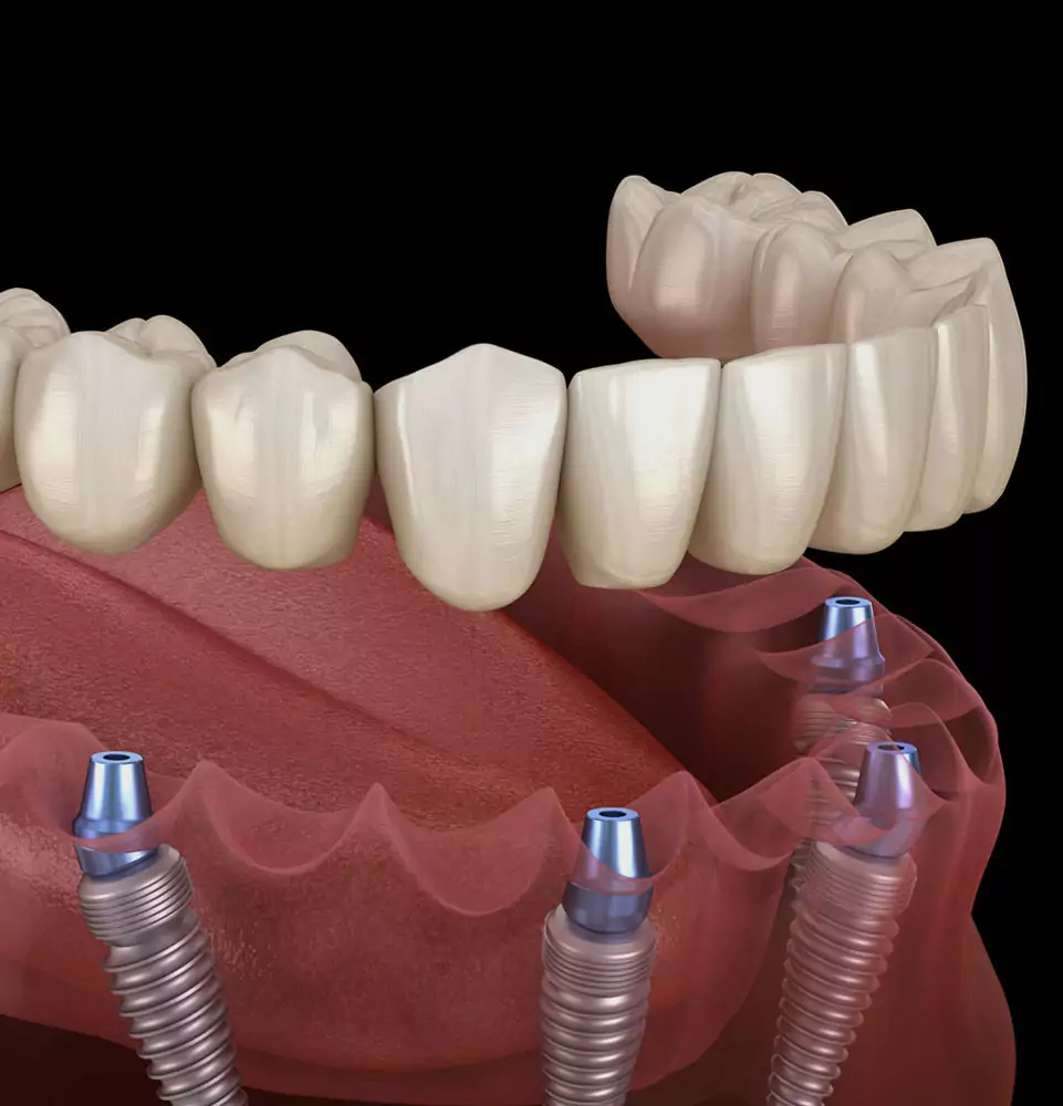 Full-Arch Dental Implants