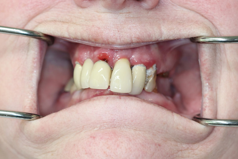 Smile before dental implant treatment