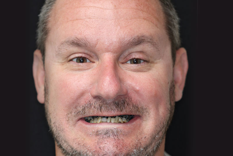 Smile before dental implant treatment