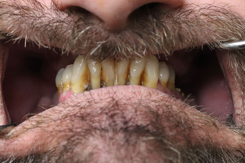 Smile before dental implant treatment